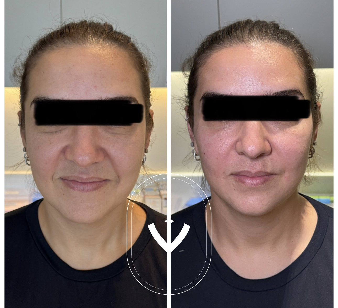 Antes e depois de tratamento dermatológico 4
