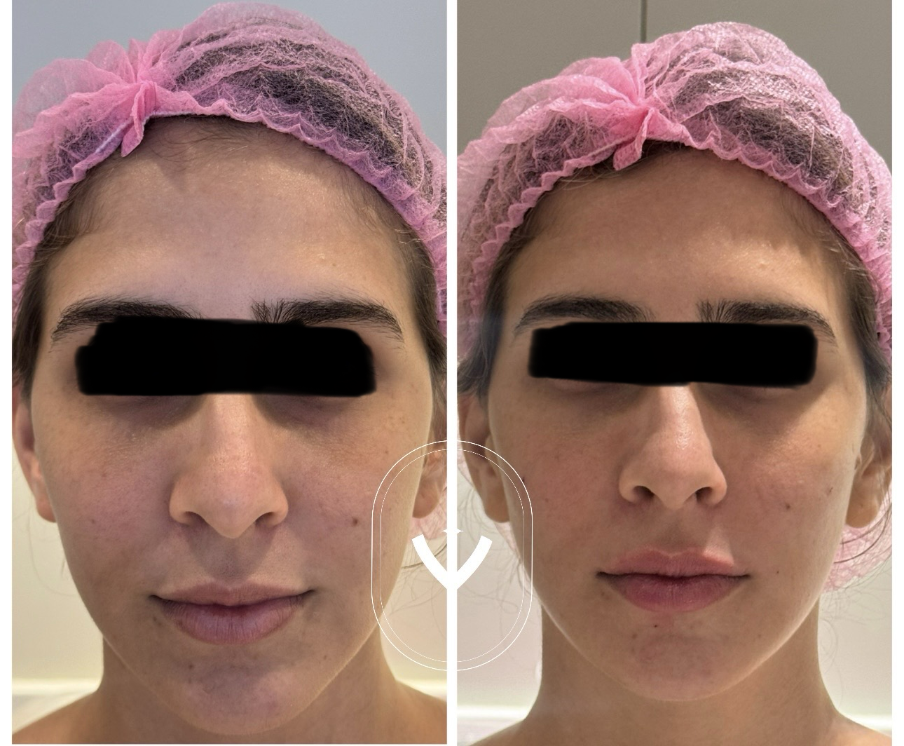 Antes e depois de tratamento dermatológico 3