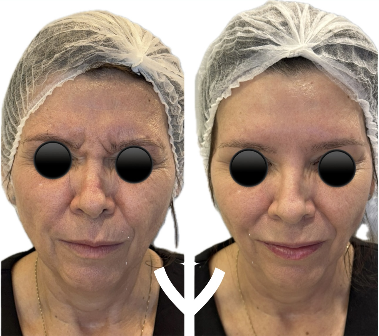 Antes e depois de tratamento dermatológico 2
